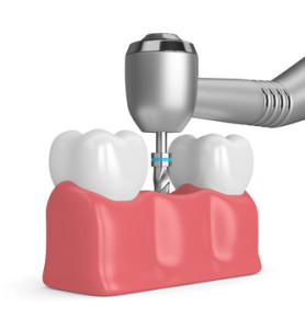 3d render of teeth with dental drill. Dental implant concept